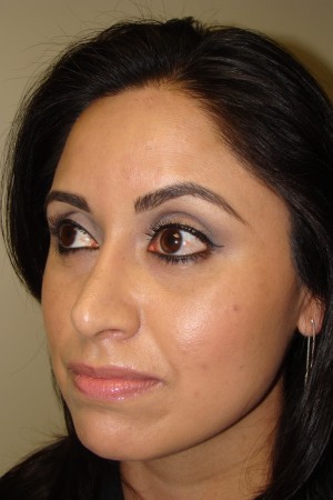 Rhinoplasty Before and After 17 | Sanjay Grover MD FACS