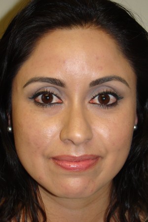 Rhinoplasty Before and After 17 | Grover Aesthetics