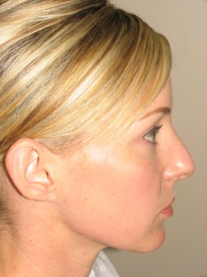 Rhinoplasty Before and After 48 | Sanjay Grover MD FACS