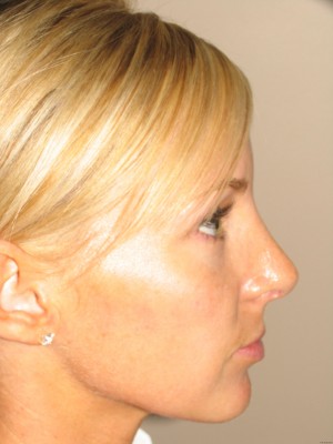 Rhinoplasty Before and After | Grover Aesthetics