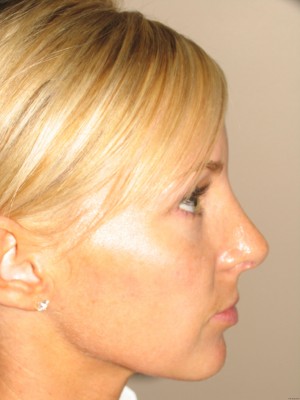 Rhinoplasty Before and After 18 | Sanjay Grover MD FACS