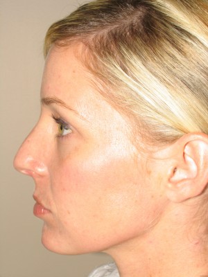 Rhinoplasty Before and After 18 | Sanjay Grover MD FACS