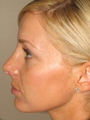 Rhinoplasty Before and After 18 | Grover Aesthetics