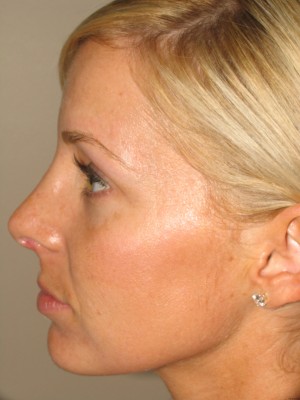 Rhinoplasty Before and After 18 | Sanjay Grover MD FACS