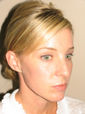 Rhinoplasty Before and After 18 | Grover Aesthetics