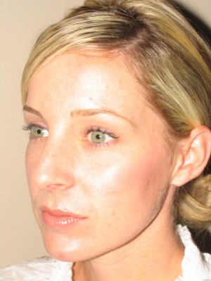 Rhinoplasty Before and After 18 | Grover Aesthetics