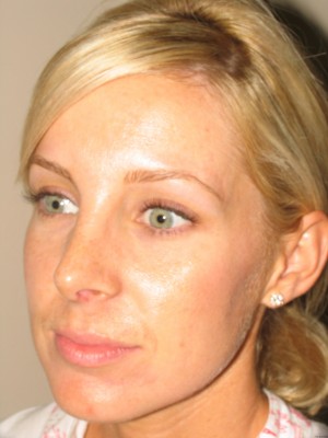 Rhinoplasty Before and After 18 | Grover Aesthetics
