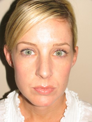Rhinoplasty Before and After 18 | Grover Aesthetics