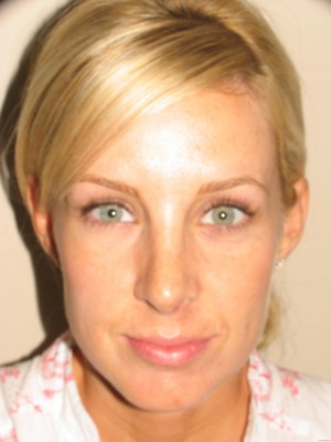 Rhinoplasty Before and After 18 | Grover Aesthetics