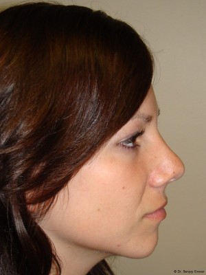 Rhinoplasty Before and After 19 | Sanjay Grover MD FACS