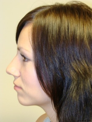 Rhinoplasty Before and After 19 | Grover Aesthetics