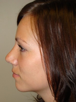 Rhinoplasty Before and After 19 | Sanjay Grover MD FACS