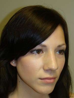 Rhinoplasty Before and After 19 | Grover Aesthetics
