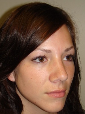 Rhinoplasty Before and After 19 | Grover Aesthetics