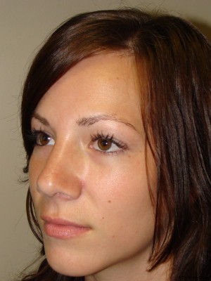 Rhinoplasty Before and After 19 | Grover Aesthetics