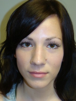 Rhinoplasty Before and After 19 | Grover Aesthetics