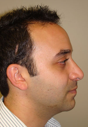 Rhinoplasty Before and After | Sanjay Grover MD FACS