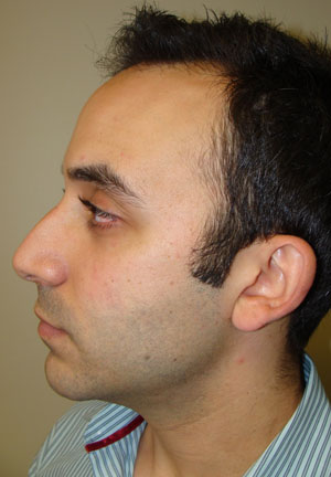 Rhinoplasty Before and After 20 | Grover Aesthetics
