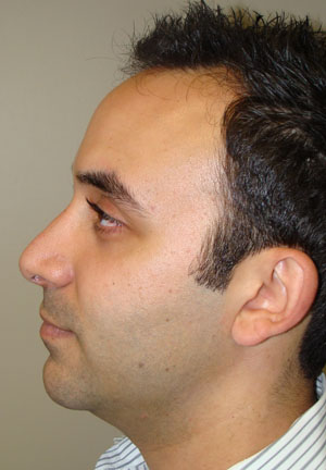 Rhinoplasty Before and After 20 | Grover Aesthetics