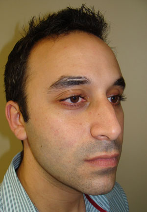 Rhinoplasty Before and After 20 | Grover Aesthetics