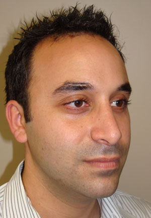 Rhinoplasty Before and After 20 | Grover Aesthetics