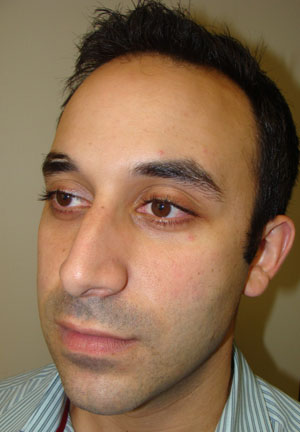 Rhinoplasty Before and After 20 | Grover Aesthetics