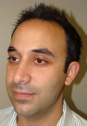 Rhinoplasty Before and After 20 | Grover Aesthetics