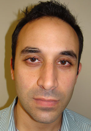 Rhinoplasty Before and After 20 | Grover Aesthetics