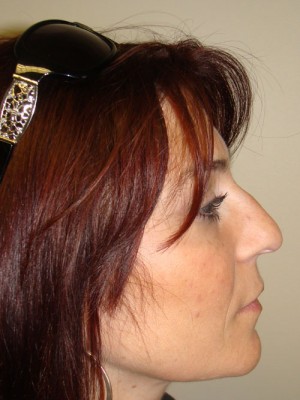 Rhinoplasty Before and After | Grover Aesthetics