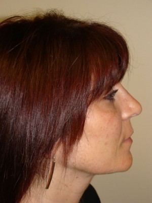 Rhinoplasty Before and After | Grover Aesthetics