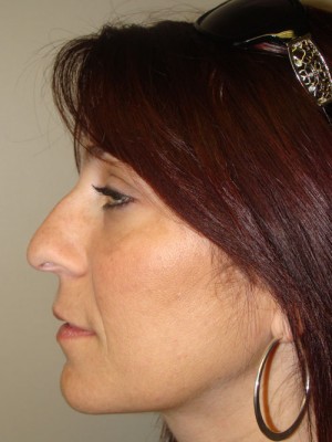 Rhinoplasty Before and After 21 | Grover Aesthetics