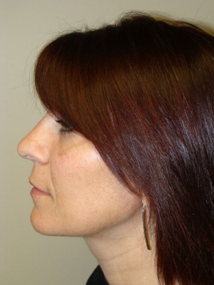 Rhinoplasty Before and After 21 | Grover Aesthetics