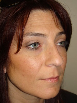 Rhinoplasty Before and After 21 | Grover Aesthetics