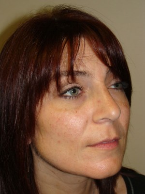 Rhinoplasty Before and After 21 | Grover Aesthetics