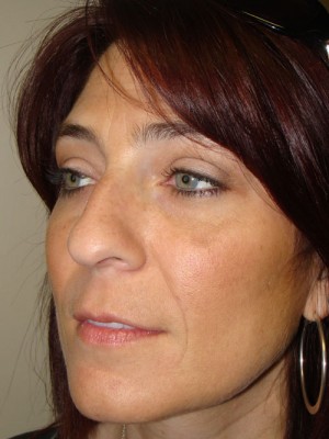 Rhinoplasty Before and After 21 | Grover Aesthetics