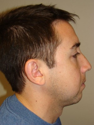 Rhinoplasty Before and After 13 | Sanjay Grover MD FACS