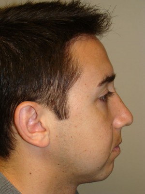 Rhinoplasty Before and After | Grover Aesthetics