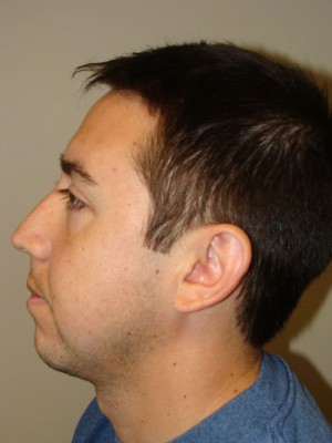Rhinoplasty Before and After 22 | Grover Aesthetics