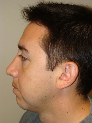 Rhinoplasty Before and After 22 | Grover Aesthetics