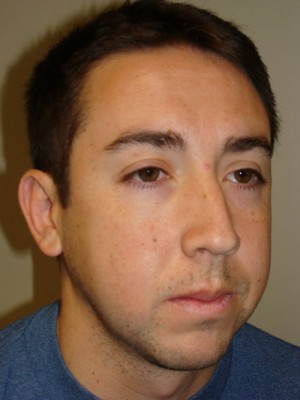 Rhinoplasty Before and After 22 | Grover Aesthetics