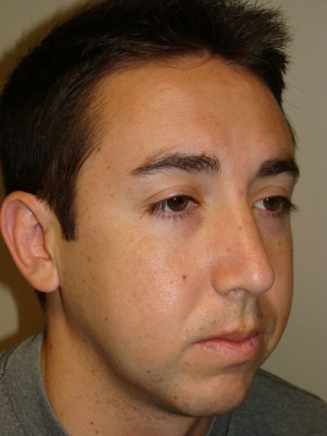 Rhinoplasty Before and After 22 | Grover Aesthetics