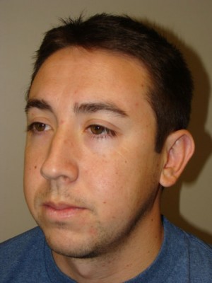 Rhinoplasty Before and After 22 | Grover Aesthetics