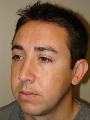 Rhinoplasty Before and After 22 | Grover Aesthetics