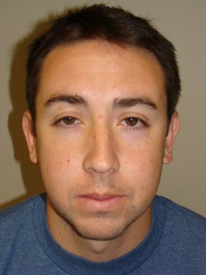 Rhinoplasty Before and After 22 | Grover Aesthetics