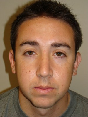 Rhinoplasty Before and After 22 | Grover Aesthetics