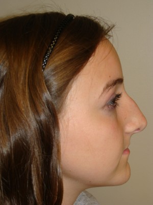 Rhinoplasty Before and After | Grover Aesthetics