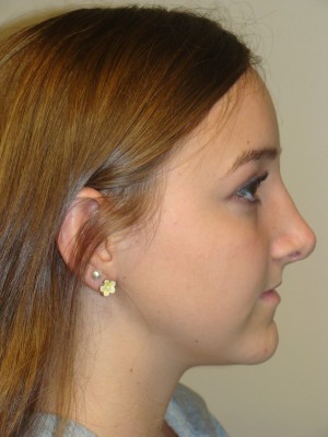 Rhinoplasty Before and After | Grover Aesthetics
