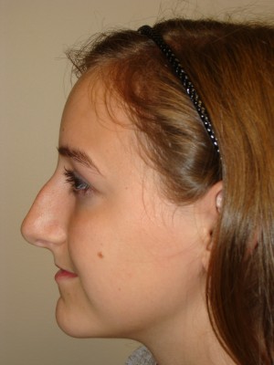 Rhinoplasty Before and After 23 | Grover Aesthetics