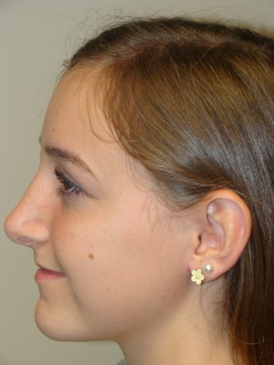 Rhinoplasty Before and After 23 | Grover Aesthetics