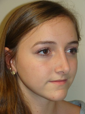 Rhinoplasty Before and After 23 | Grover Aesthetics